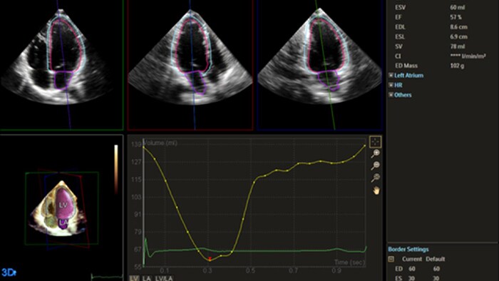 Image showing quantification through Philips Dynamic HeartModel