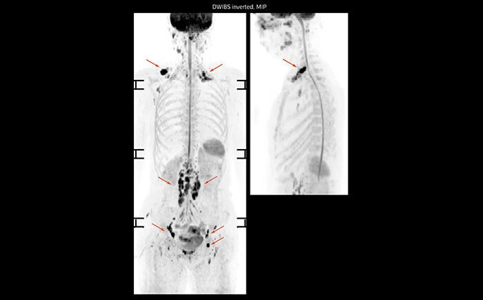 Prodiva MRI whole body DWI lymphoma, Seirei Mikatahara