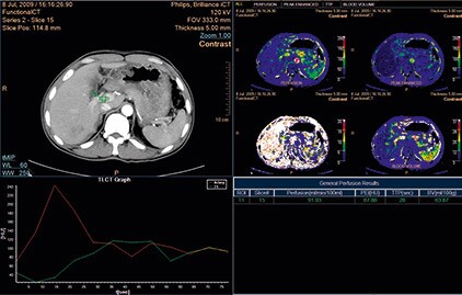 ct-body-pefusion