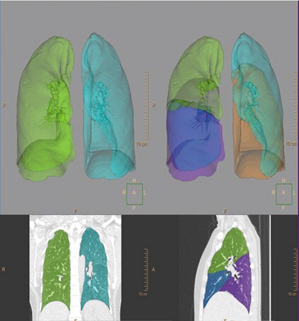 ct-copd