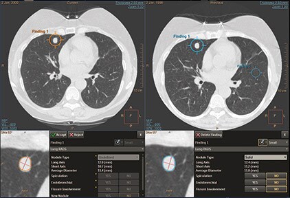 ct-lung-nodule-assessment