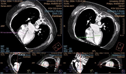 ct-pulmonary-artery-analysis