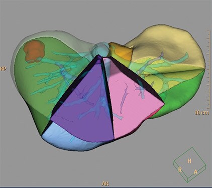 ct-liver-analysis