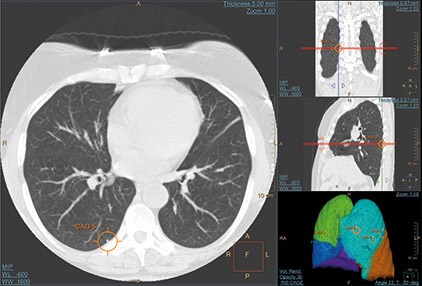 ct-lung-nodule-cad