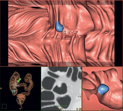 ct-virtual-colonoscopy