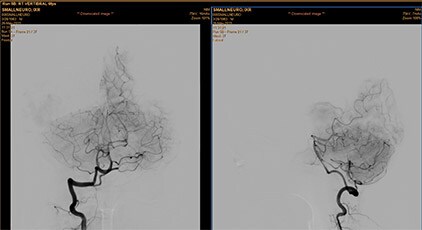 xa-vascular-processing-dsa-in-mmv