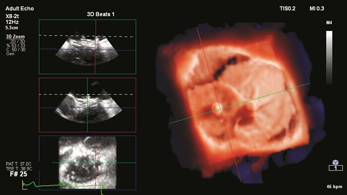 Intravascular Ultrasound (IVUS)