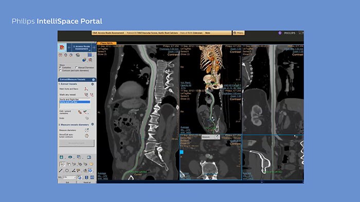 IntelliSpace Portal TAVI Planning