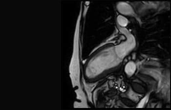 Acute Myocardinal