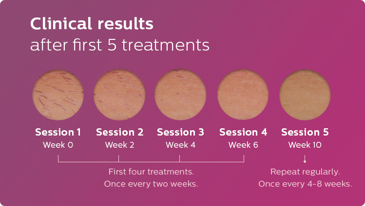 Clinical results after first 5 treatments